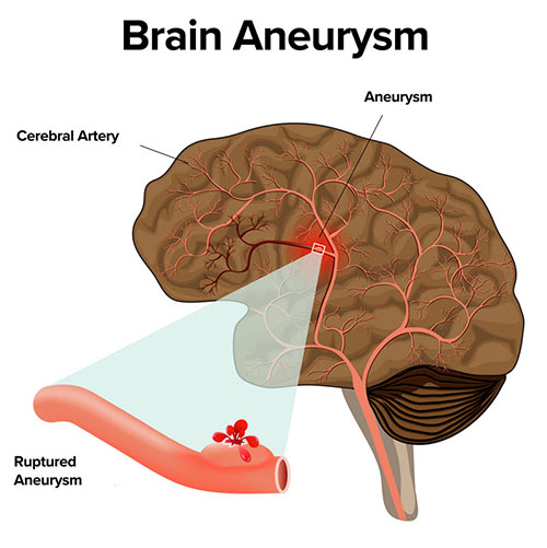 چرا امیلیا کلارک دو بار تا نزدیکی مرگ پیش رفتهاست؟ چرا امیلیا کلارک دو بار تا نزدیکی مرگ پیش رفتهاست؟