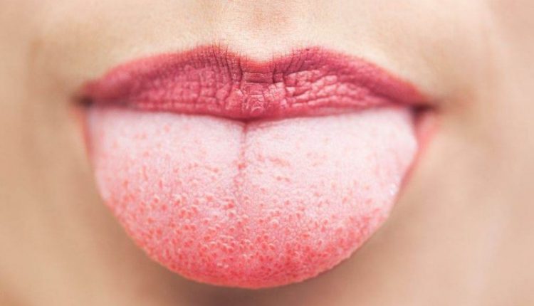 زبان سفید؛ بررسی علتها، انواع و نحوه درمان علت سفیدی زبان