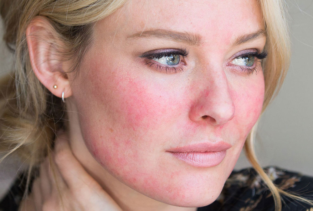 علت سرخی پوست صورت و بهترین راه های درمان آن