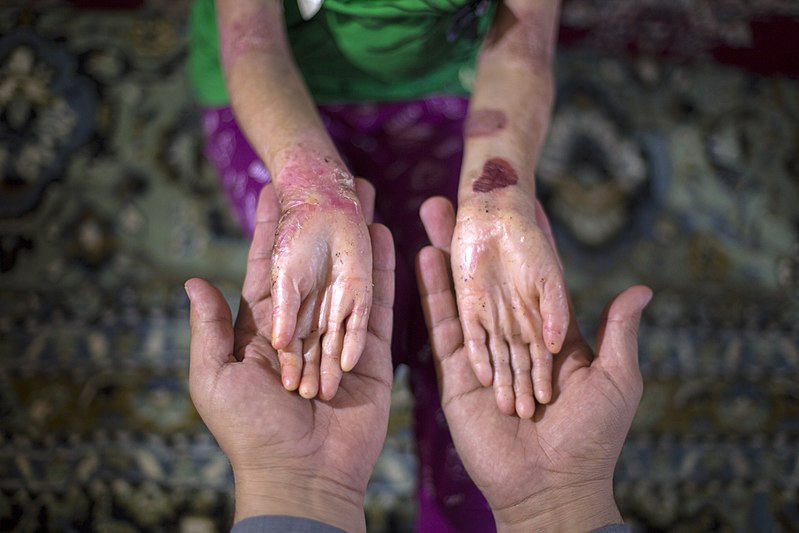 موجودی پانسمان بیماران پروانه ای تا یک ماه