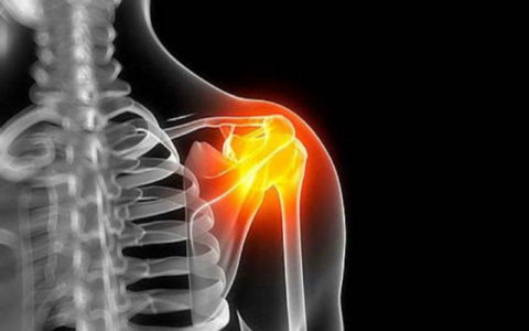 ۷۰ درصد مبتلایان به شانه خشک زنان هستند