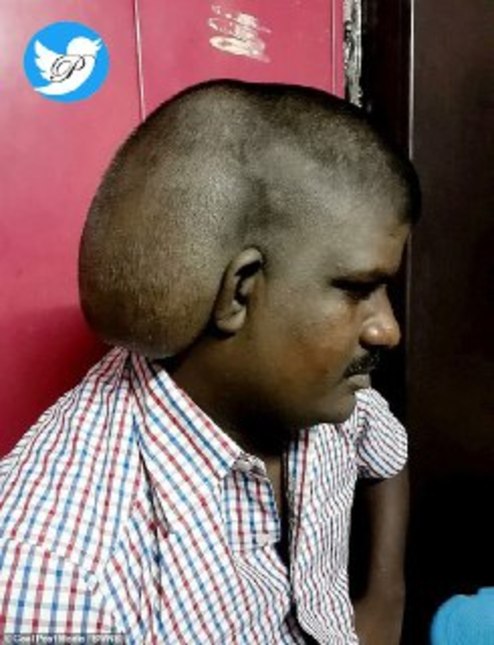 جراحی بزرگترین تومور مغزی جهان +عکس