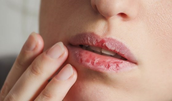 علل و راه‌های درمان خشکی لب