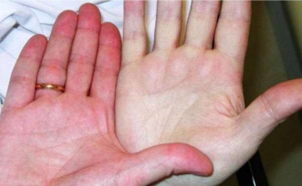 نشانه‌های کم خونی را بشناسید