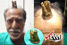 خارج کردن شاخ شیطان از سر مرد هندی! +عکس