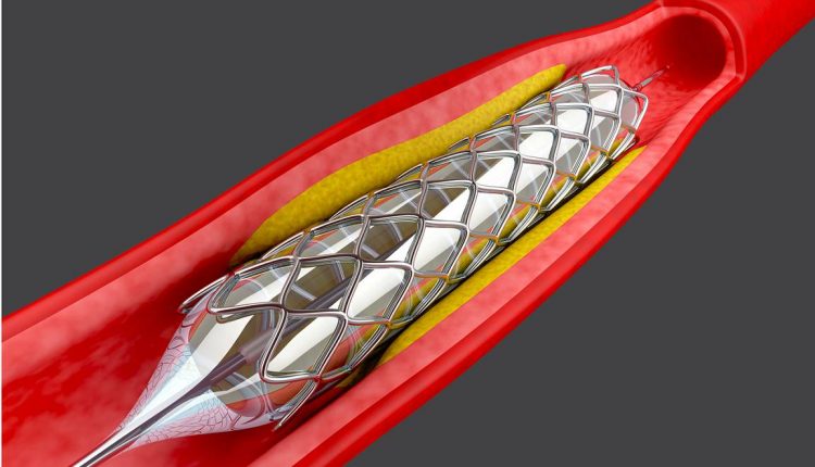 آنژیوگرافی قلب