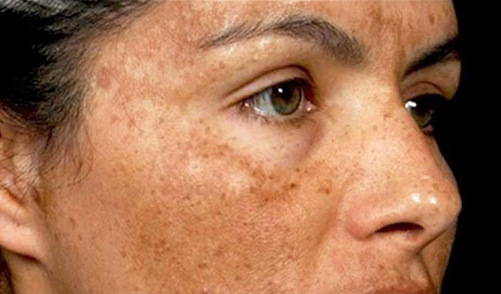 ۹ روش برای از بین بردن لکه‌های قهوه‌ای پوست