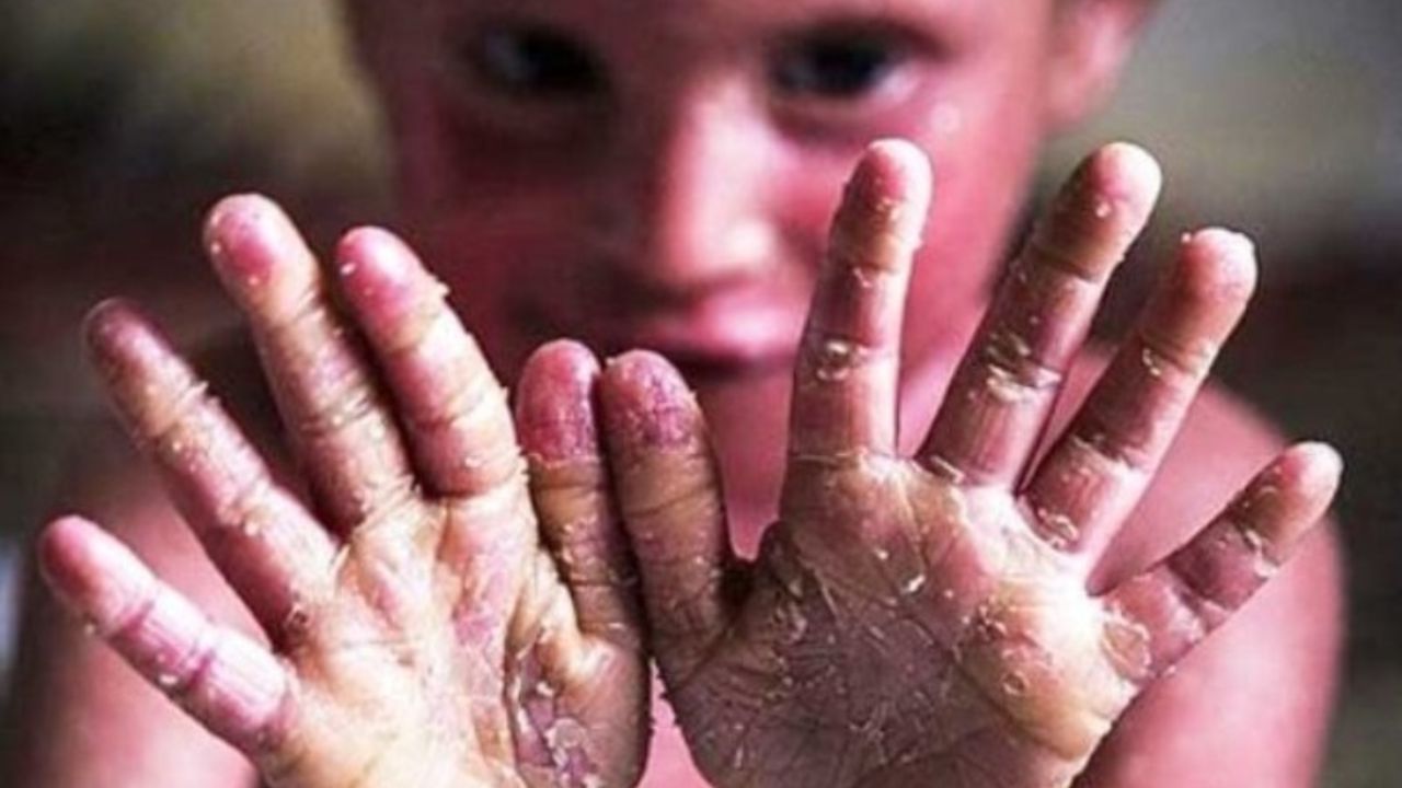 راهکار‌های عضو کمیسیون بهداشت مجلس برای بیماران پروانه‌ای/ تولید پانسمان مخصوص به صرفه نیست