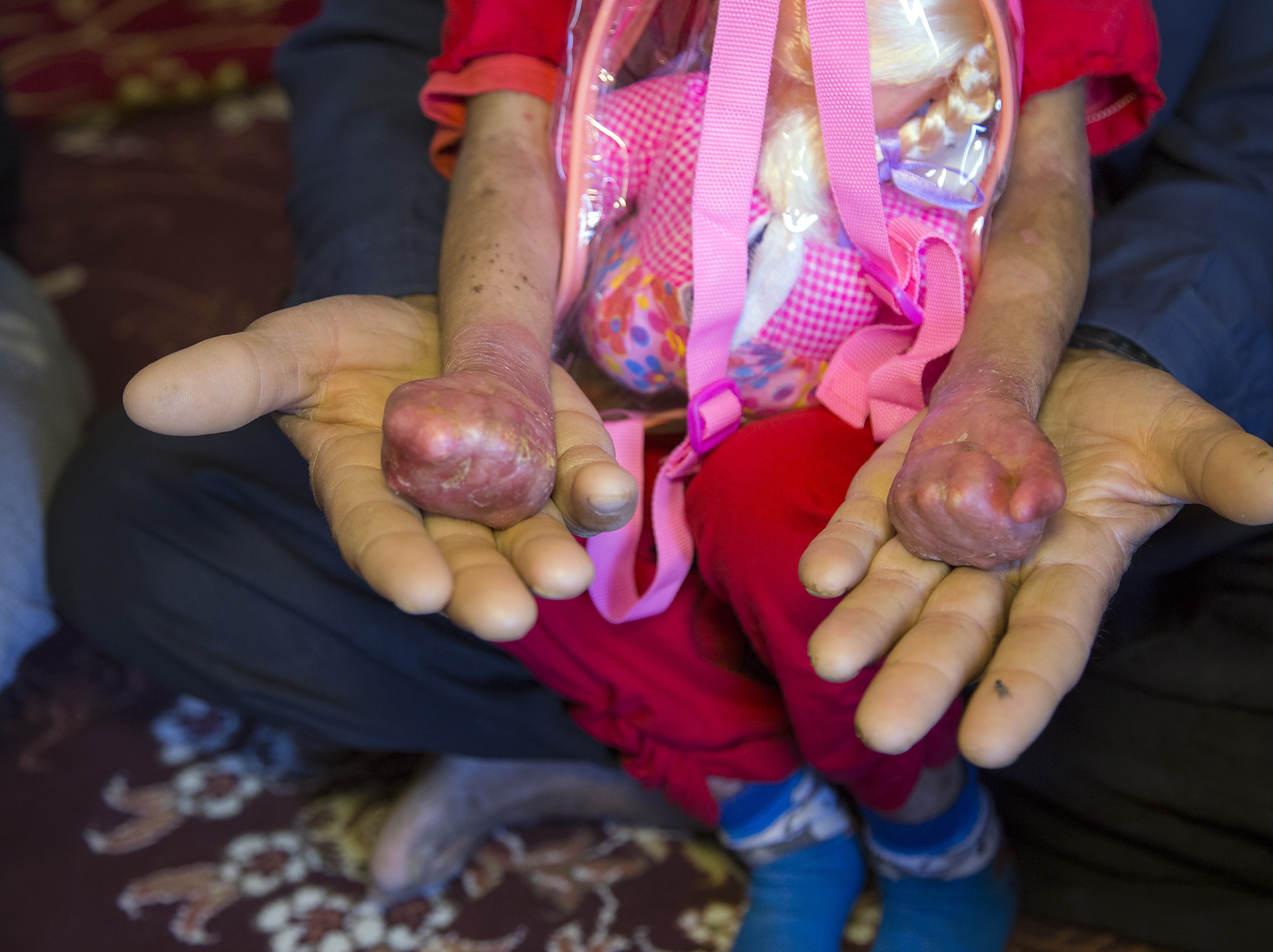 بیمار پروانه ای