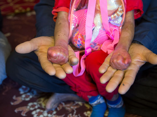 هزینه ماهانه بیماران پروانه‌ای چقدر است؟