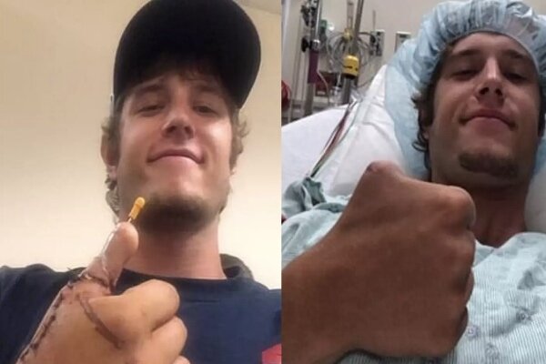 پیوند انگشت پا به جای شست دست!