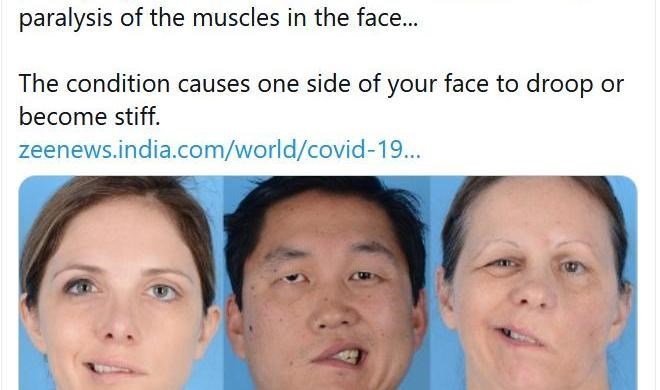 تمام عوارض و پیامدهای تزریق واکسن کرونای فایزر