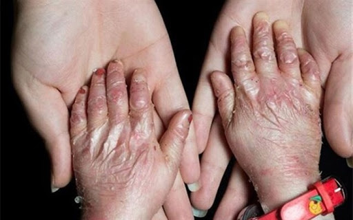 پانسمان بیماران پروانه ای 