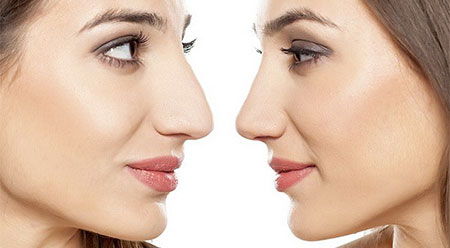 جراحی بینی گوشتی