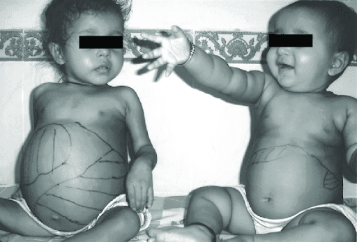 بیماری های نادر