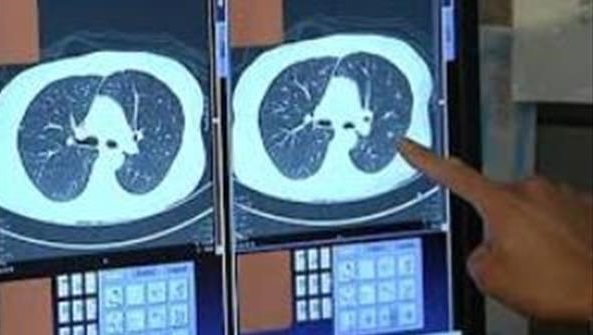 بیماران کووید ۱۹ بازتوانی ریوی می&zwnj;شوند