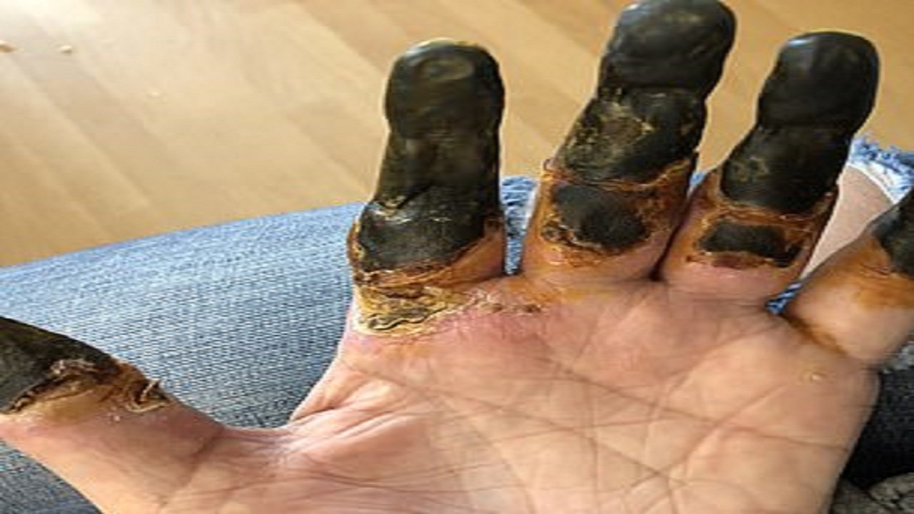 کرونا باعث قطع انگشتان یک مرد شد