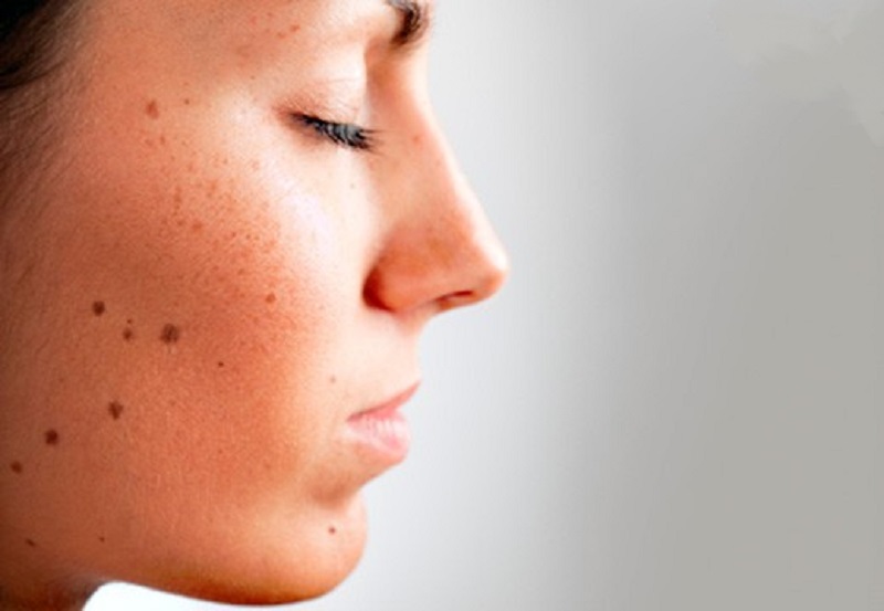 گونه های مختلف خال