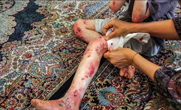 زندگی با زخم پروانه‌ای