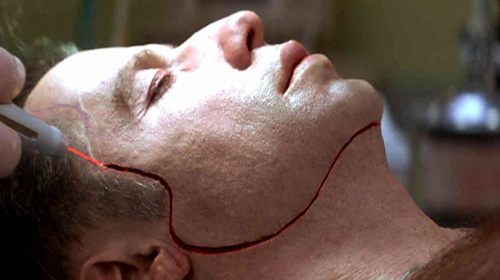 اعمل پیوند صورت عمل پیوند صورت