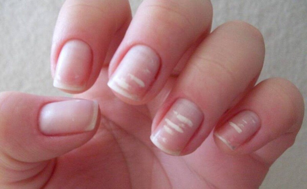 کمبود کلسیم