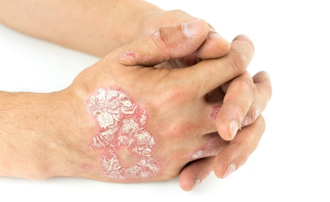 بیماری پوستی پسوریازیس، علائم و روش درمان