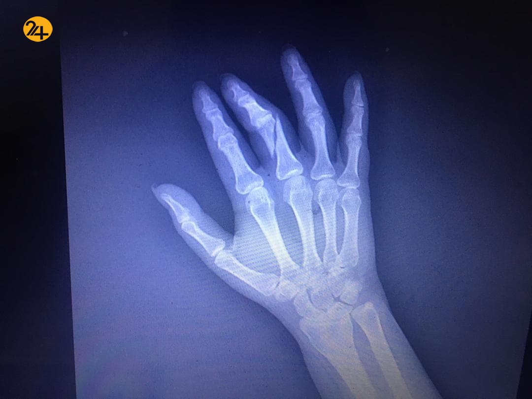 شکستن دست خبرنگار رویداد24