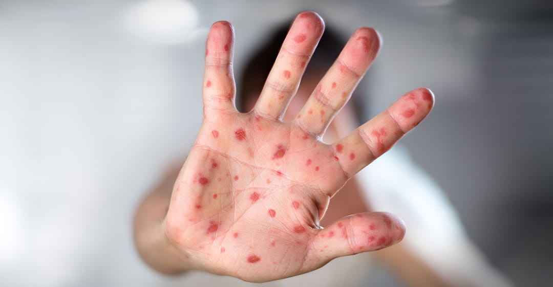 سرخک؛ مسری‌ترین بیماری عفونی است/ خطر عدم واکسیناسیون کودکان