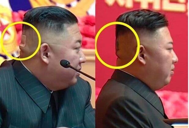 انتشار تصویری جدید از رهبر کره‌شمالی با سر بانداژ شده +عکس