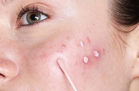 جوش هر نقطه از صورت نشانهی چیست؟ جوش هر نقطه از صورت نشانهی چیست؟