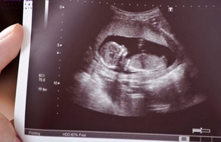 طرح غربالگری