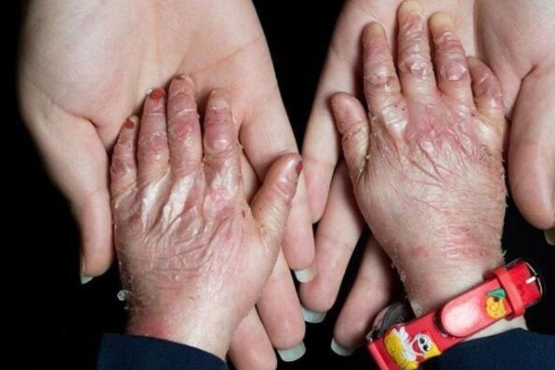 درخواست برای ورود قضایی به موضوع گم شدن ۲۵۰۰ کیلو پانسمان بیماران پروانه&zwnj;ای