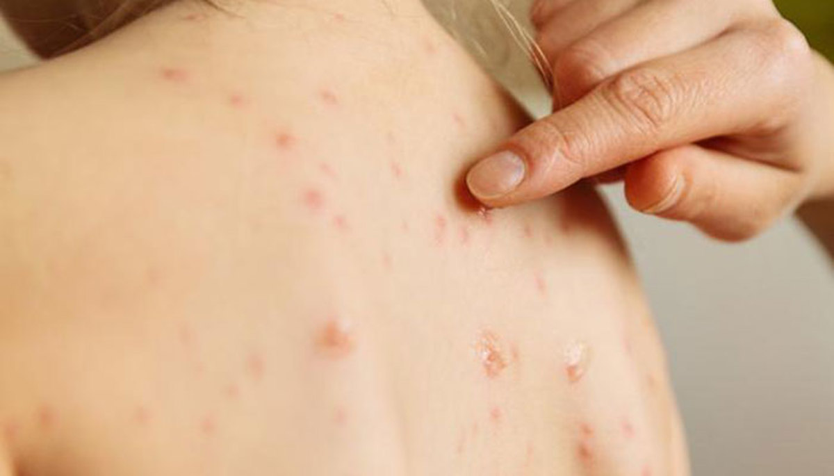 کدام کودکان باید علیه سرخک واکسینه شوند؟ کدام کودکان باید علیه سرخک واکسینه شوند؟