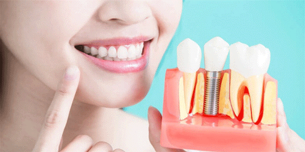ایمپلنت دندان