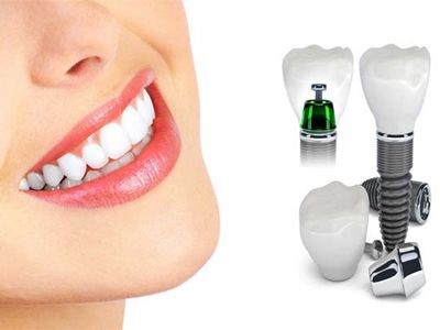 ایمپلنت دندان چیست؟ ایمپلنت دندان چیست؟