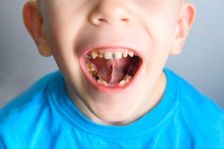 پوسیدگی دندان با خوردن نوشابه 