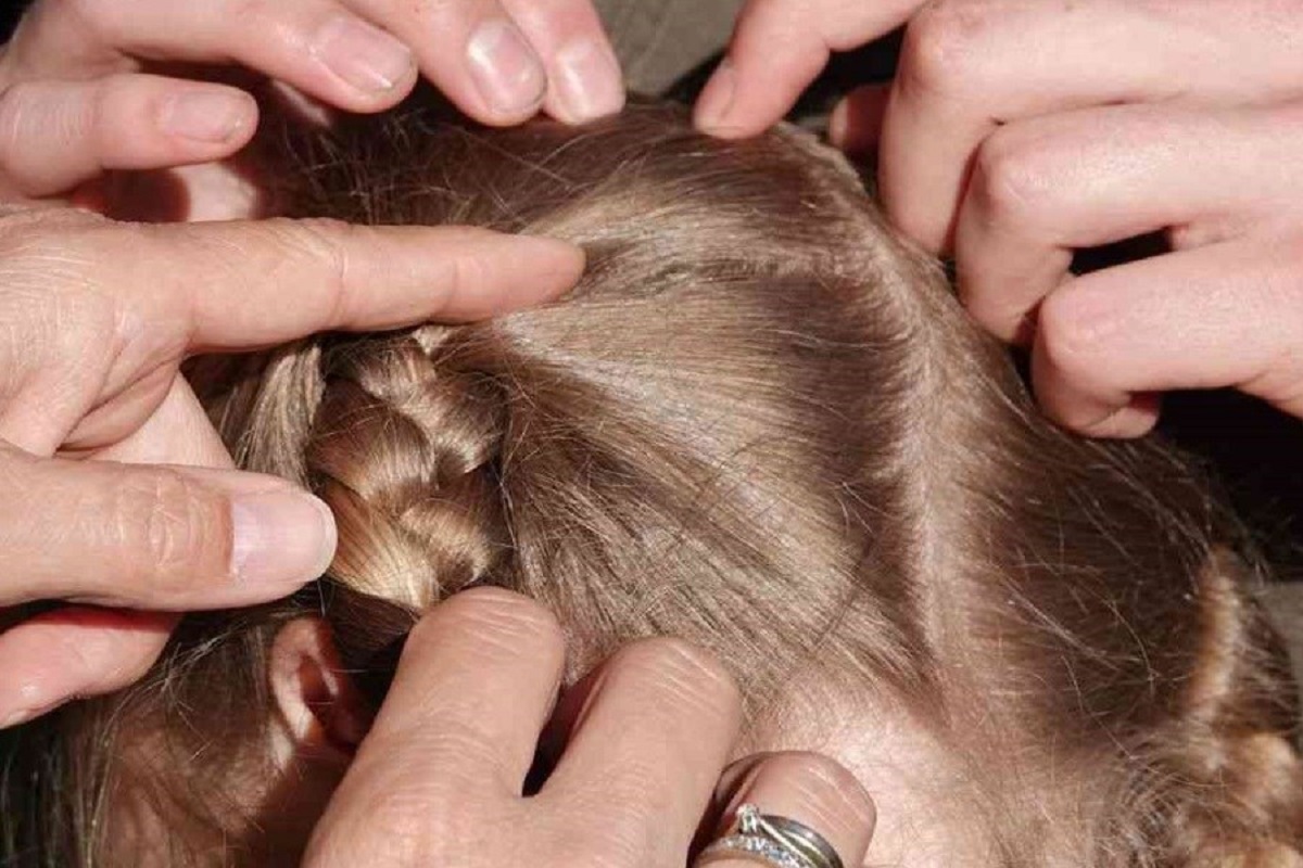 روشهای درمان خانگی شپش روشهای درمان خانگی شپش