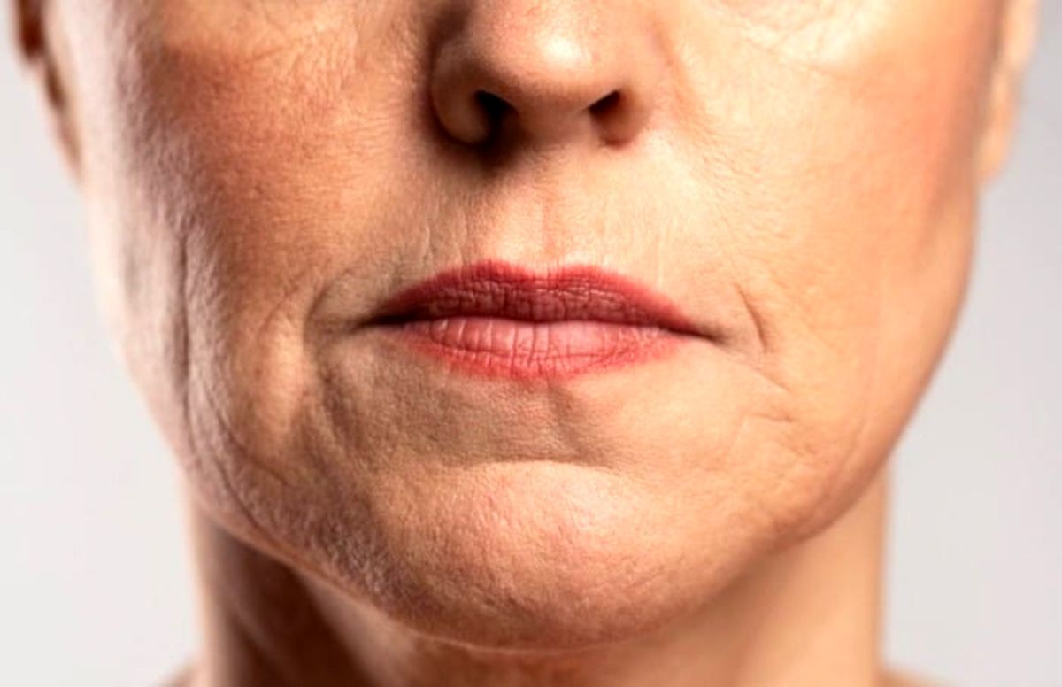 عوارض جدی استفاده از لیف برای پوست صورت