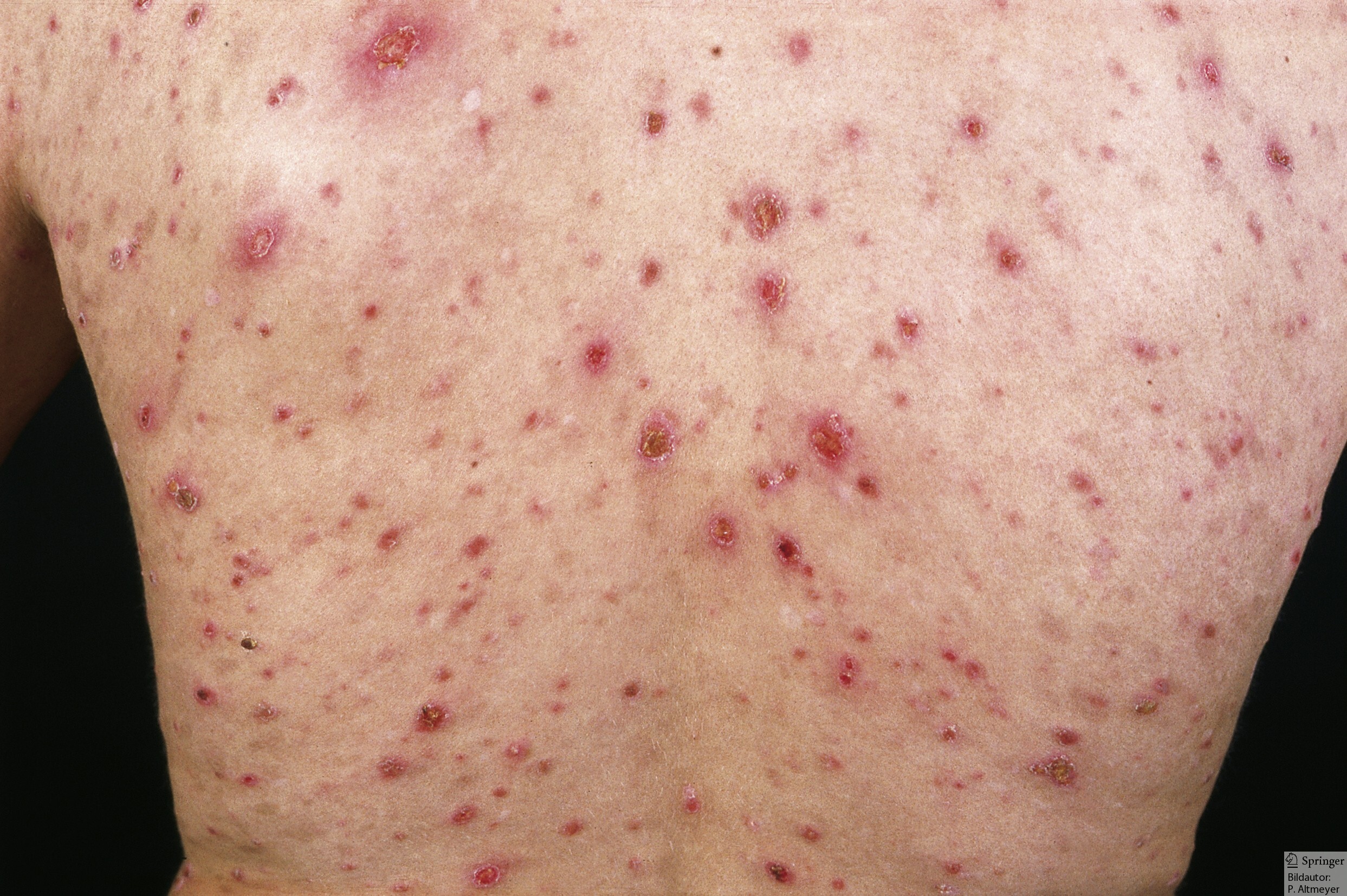 بیماری پی ال سی چیست؟