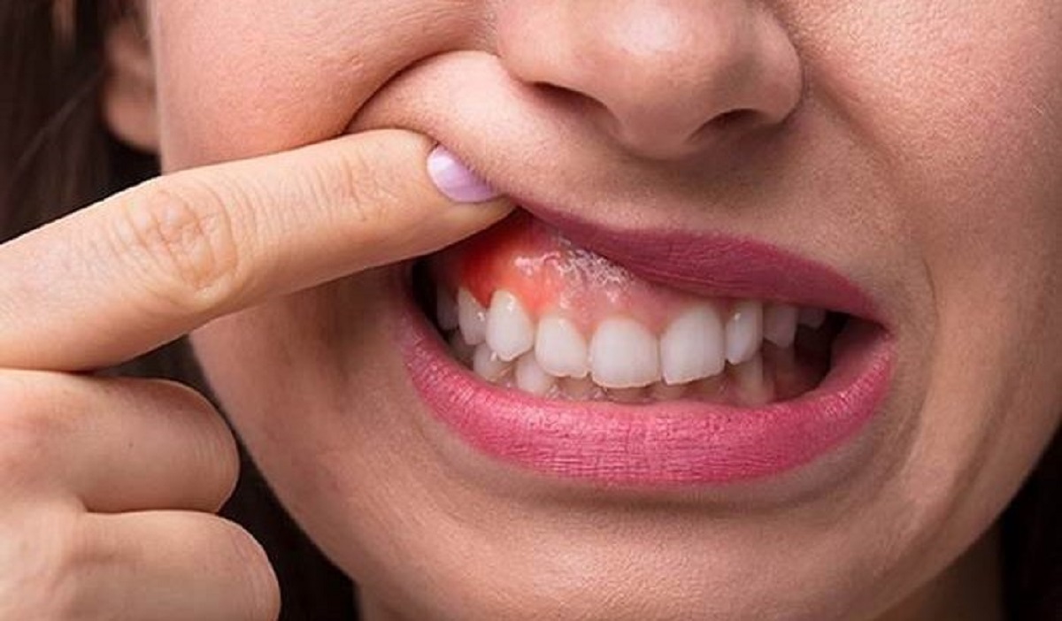 راهکار خوابیدن سریع ورم لثه راهکار خوابیدن سریع ورم لثه