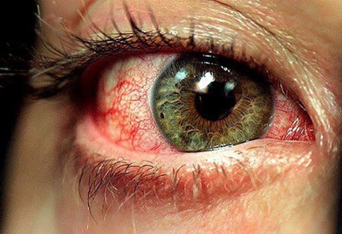 قرمز شدن چشم نشانه چیست؟