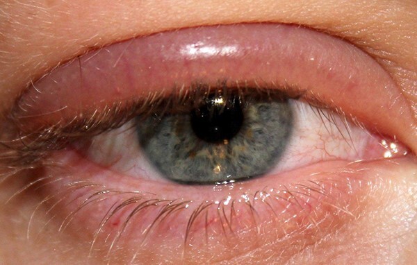 علل سنگینی پلک و خواب آلودگی