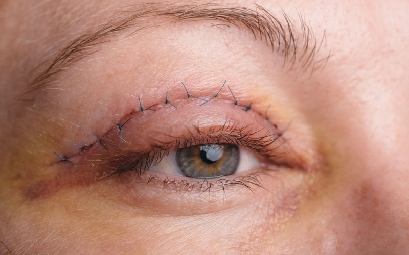 علل سنگینی پلک و خواب آلودگی