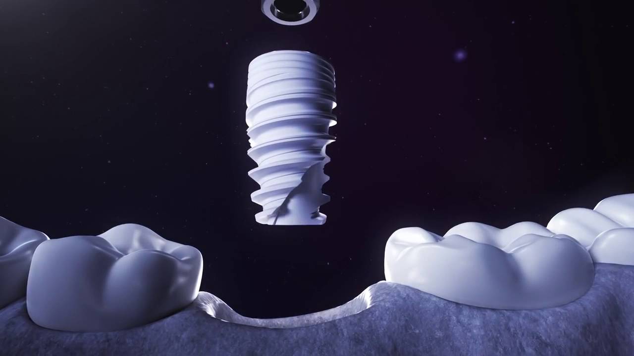 ایمپلنت فوری