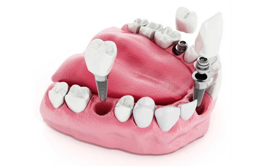 ایمپلنت فوری دیجیتال