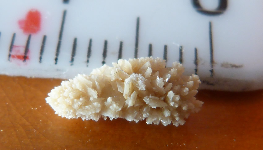 درمان سنتی سنگ کلیه