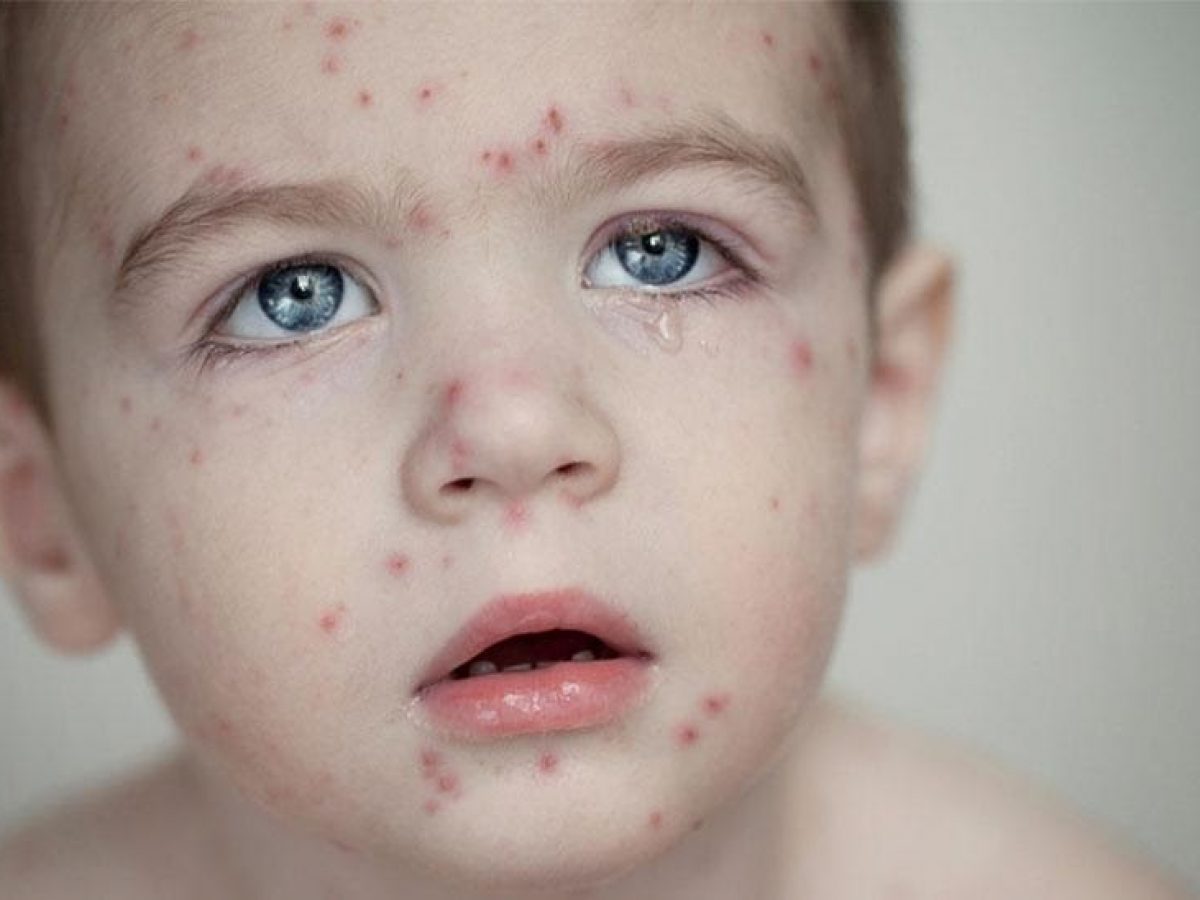 علائم ابتلا به سرخک