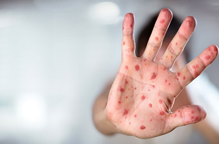 علائم ابتلا به سرخک