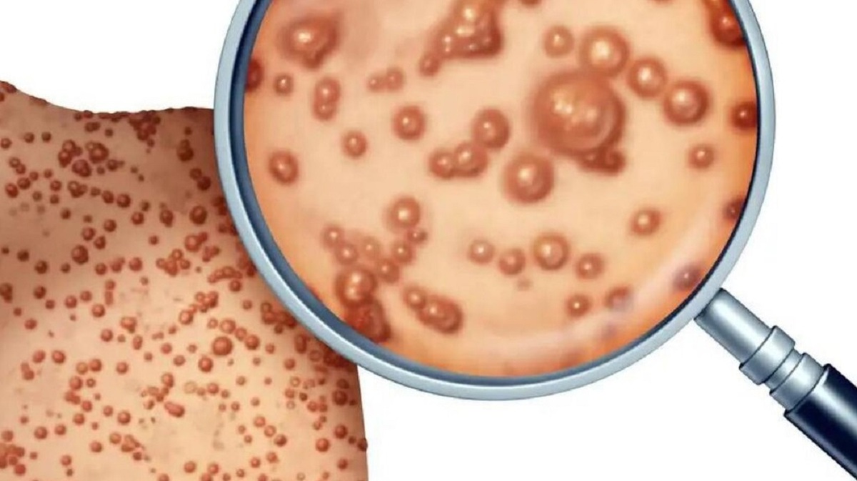 علائم ابتلا به آبله میمون