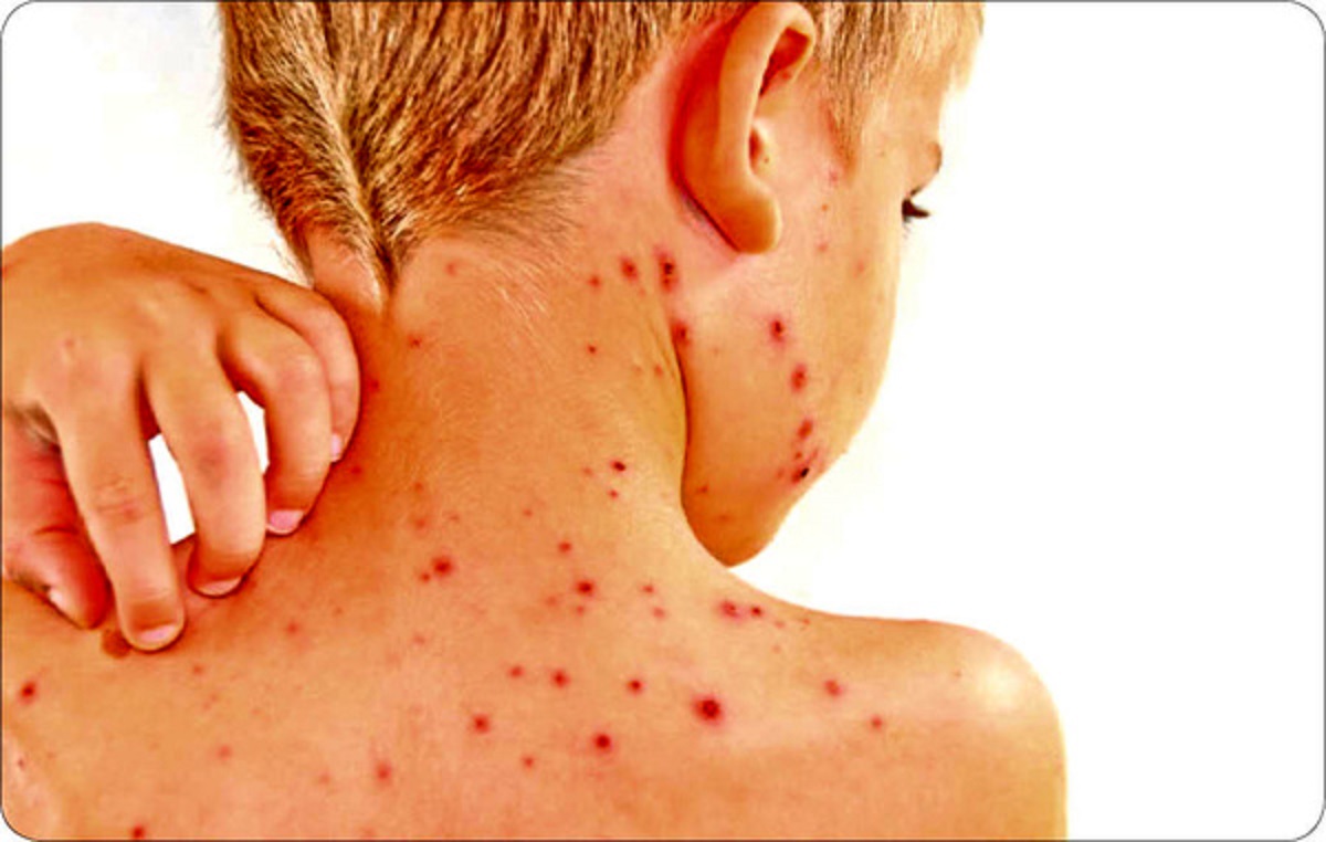 علائم ابتلا به آبله میمونی